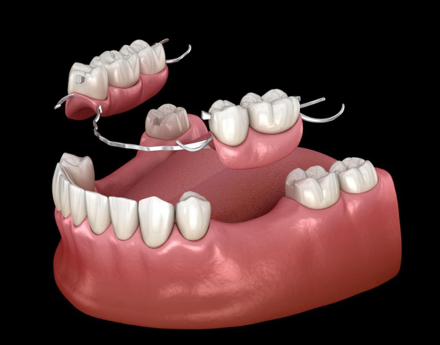A graphic of partial dentures