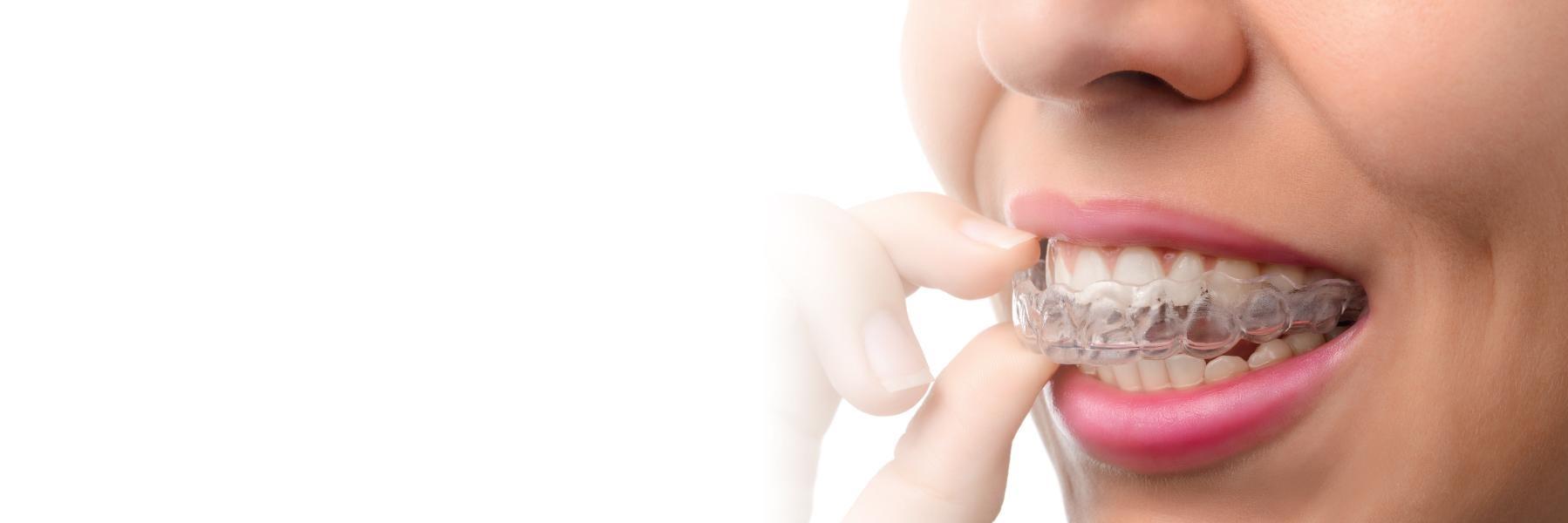 Invisalign Clear Braces in Jensen Beach and Stuart, FL