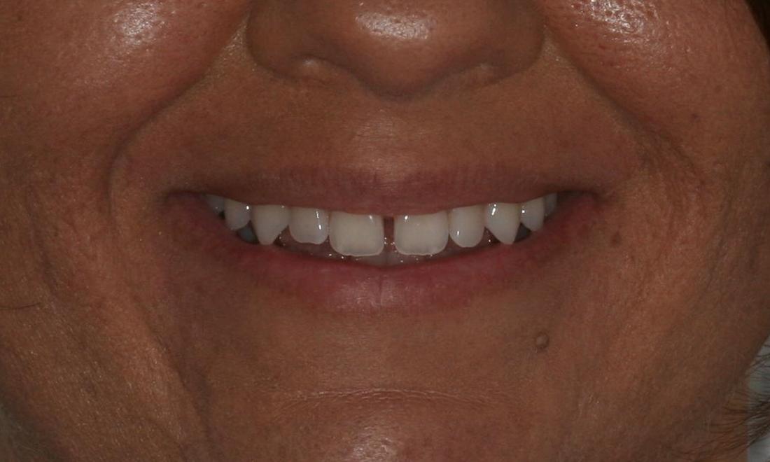 image of teeth with gap in the front | Jensen Beach FL