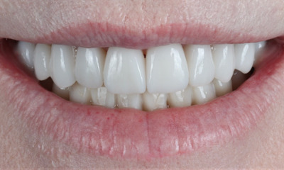 Dental-Crowns-Veneers-Case-2-After-Image