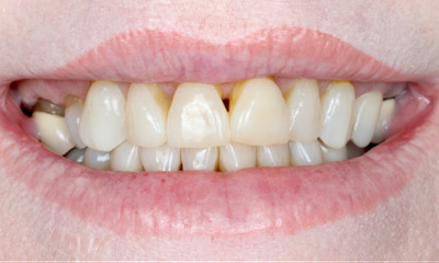 Dental-Crowns-Veneers-Case-2-Before-Image
