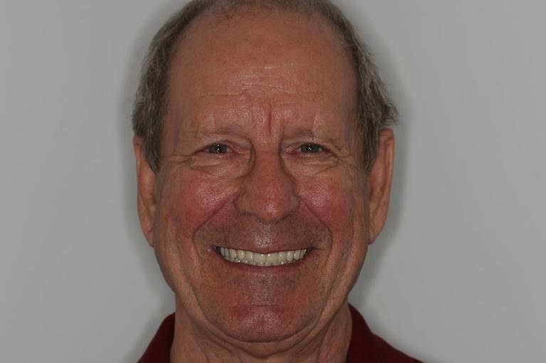 teeth with dental crowns at Jensen Beach FL